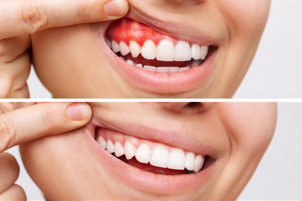 Gum Infections: Causes, Symptoms, Treatment, and Prevention