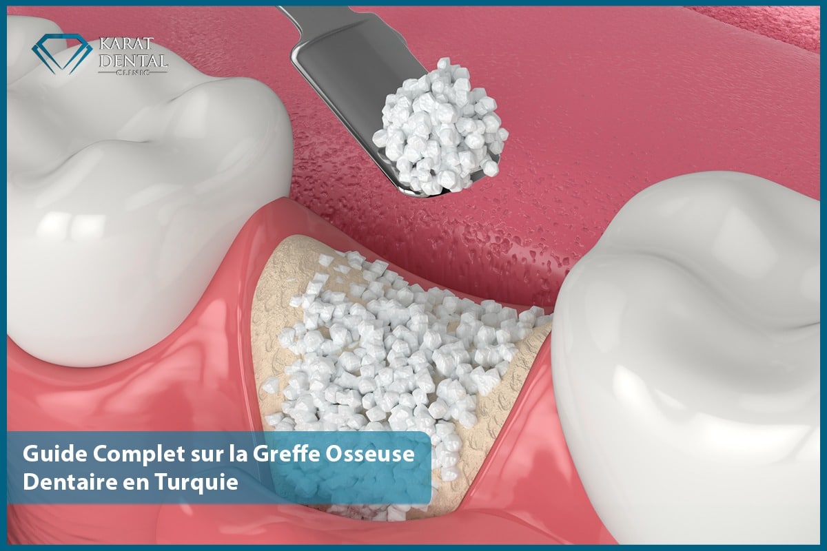 Guide Complet sur la Greffe Osseuse Dentaire en Turquie