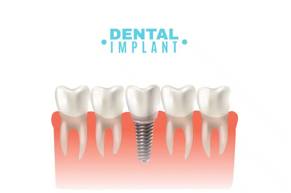Implant Dentaire de Meilleure Marque Guide Complet avec Karat Dental Clinic à Istanbul