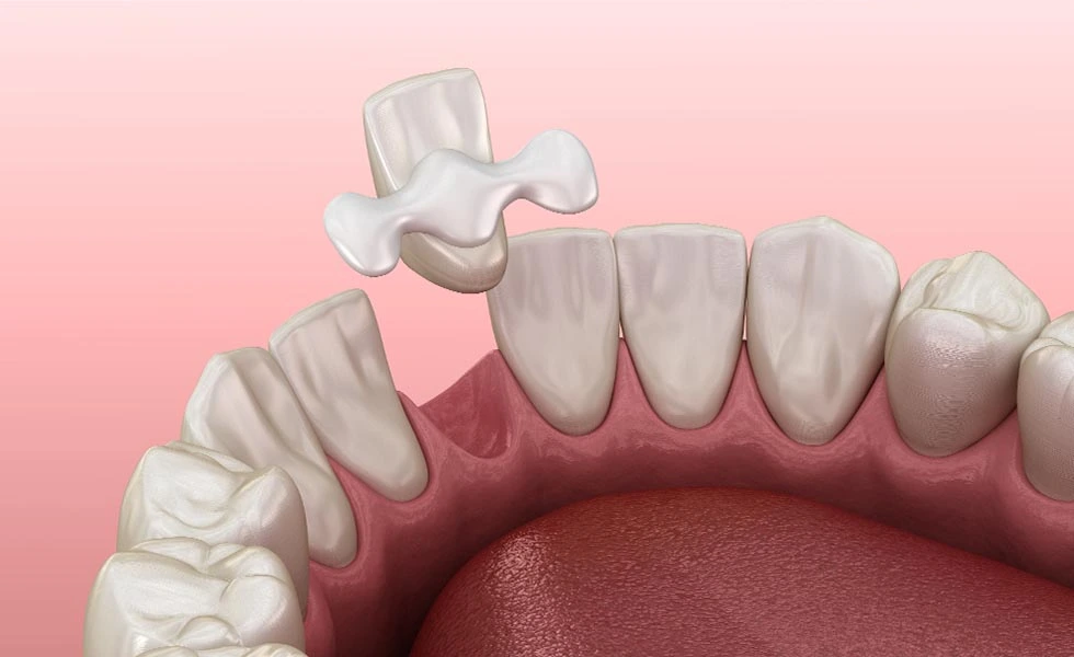 Maryland Bridge: A Complete Guide to One of the Most Popular Tooth Replacement Options