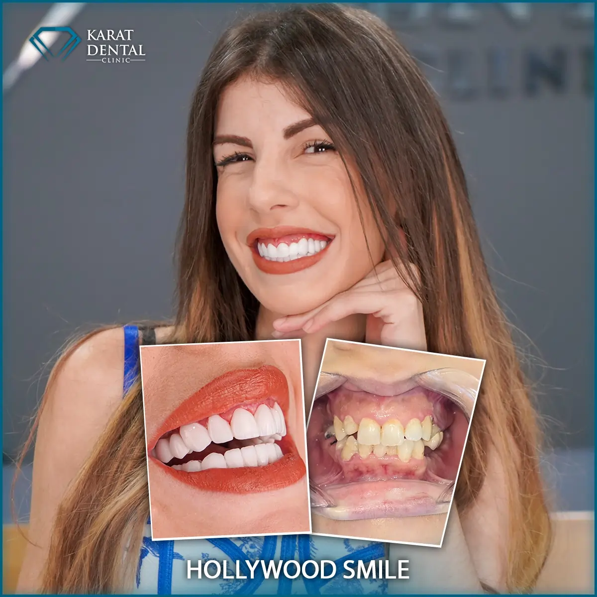 Hollywood Smile Istanbul