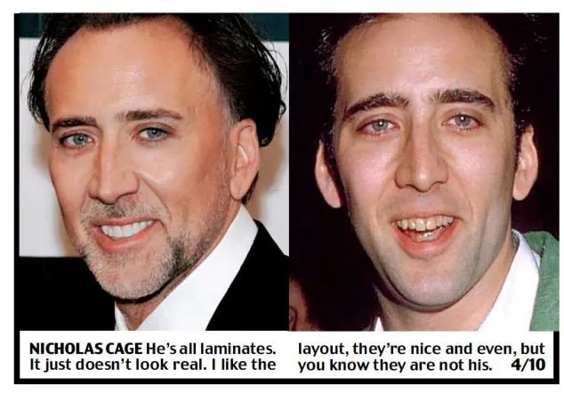 Nicolas Cage Teeth Before and After