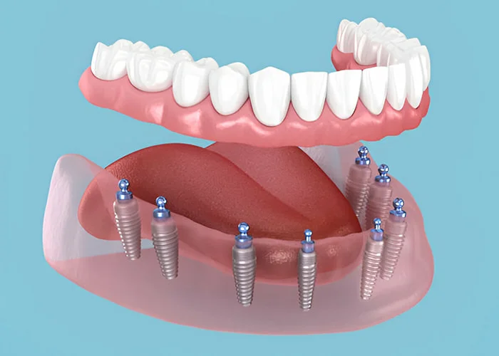 All-on-8 Dental Implants Turkey