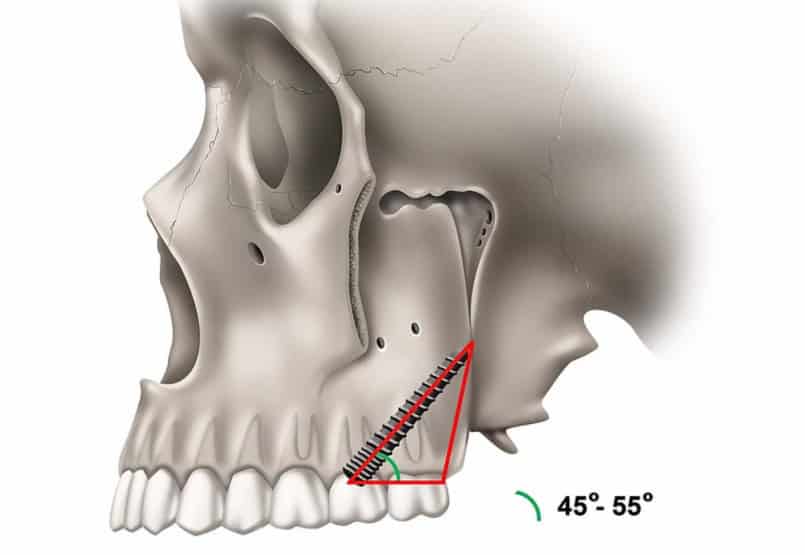 Pterygoid Implants