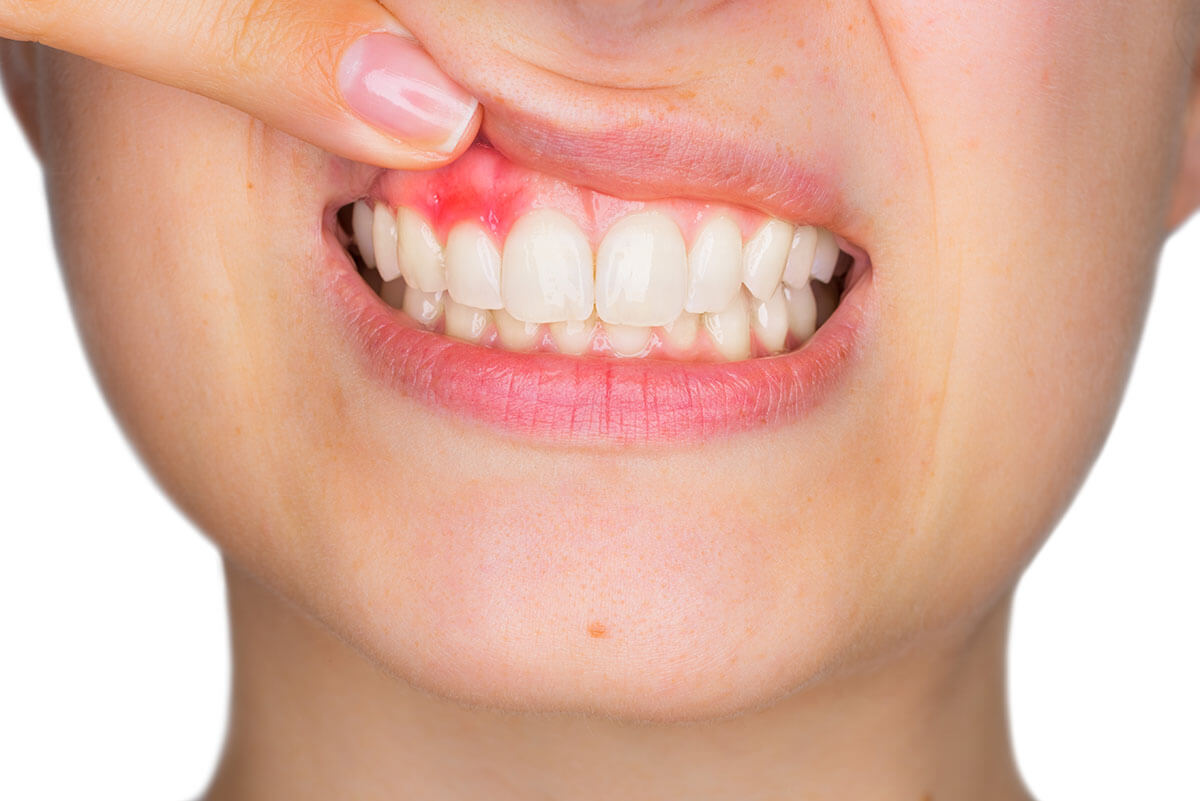 inflamed gums
