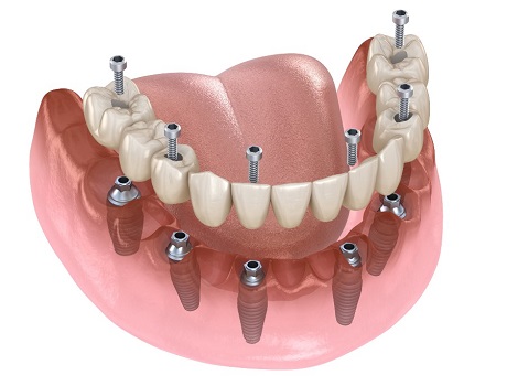 all on 6 dental implants