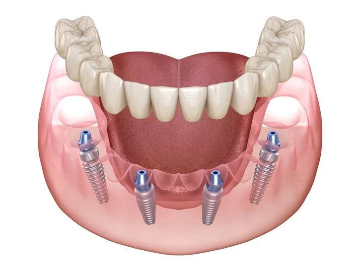 Dental Implants Procedure