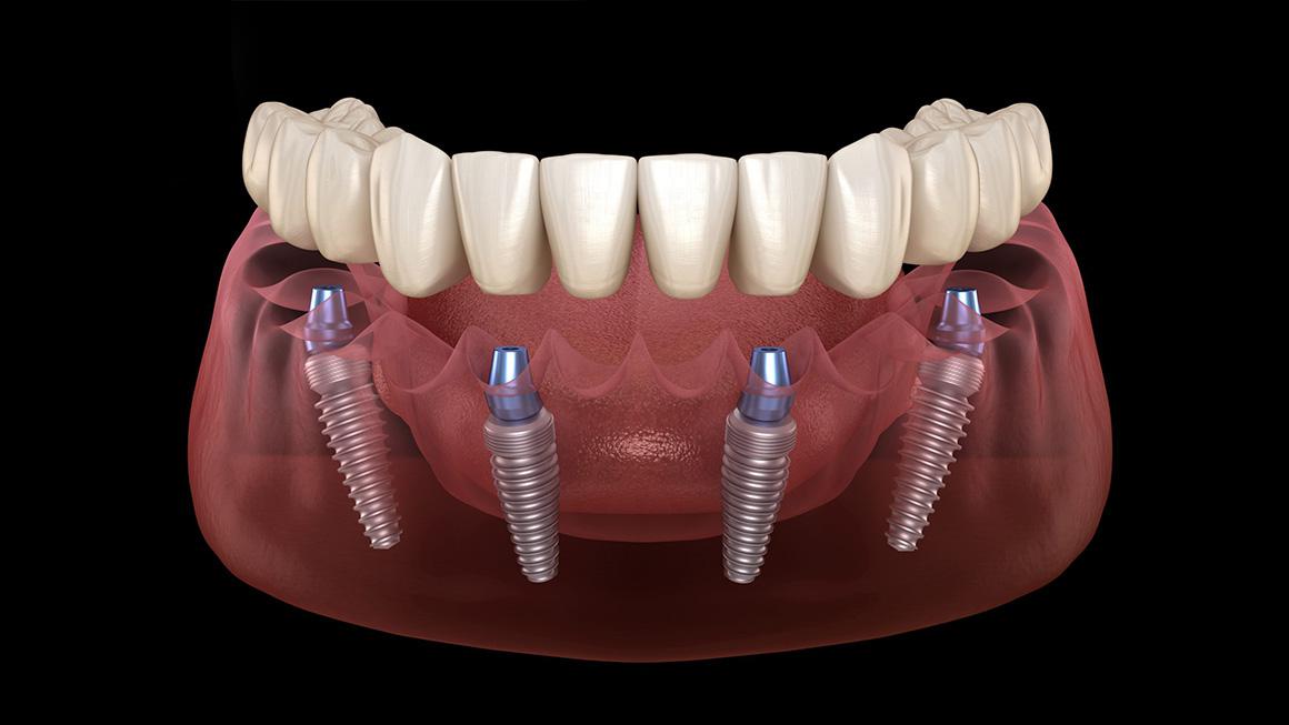 All on 4 Dental Implants Turkey