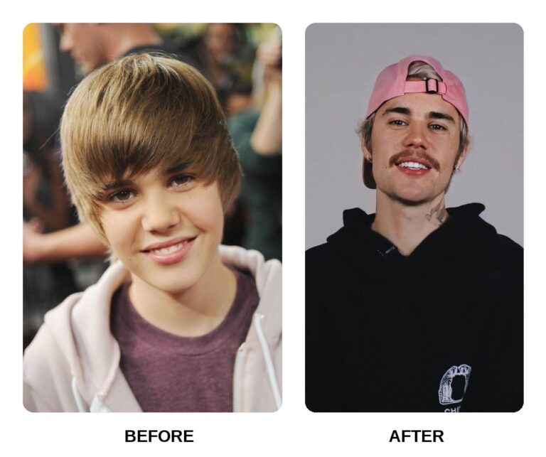 justin bieber teeth