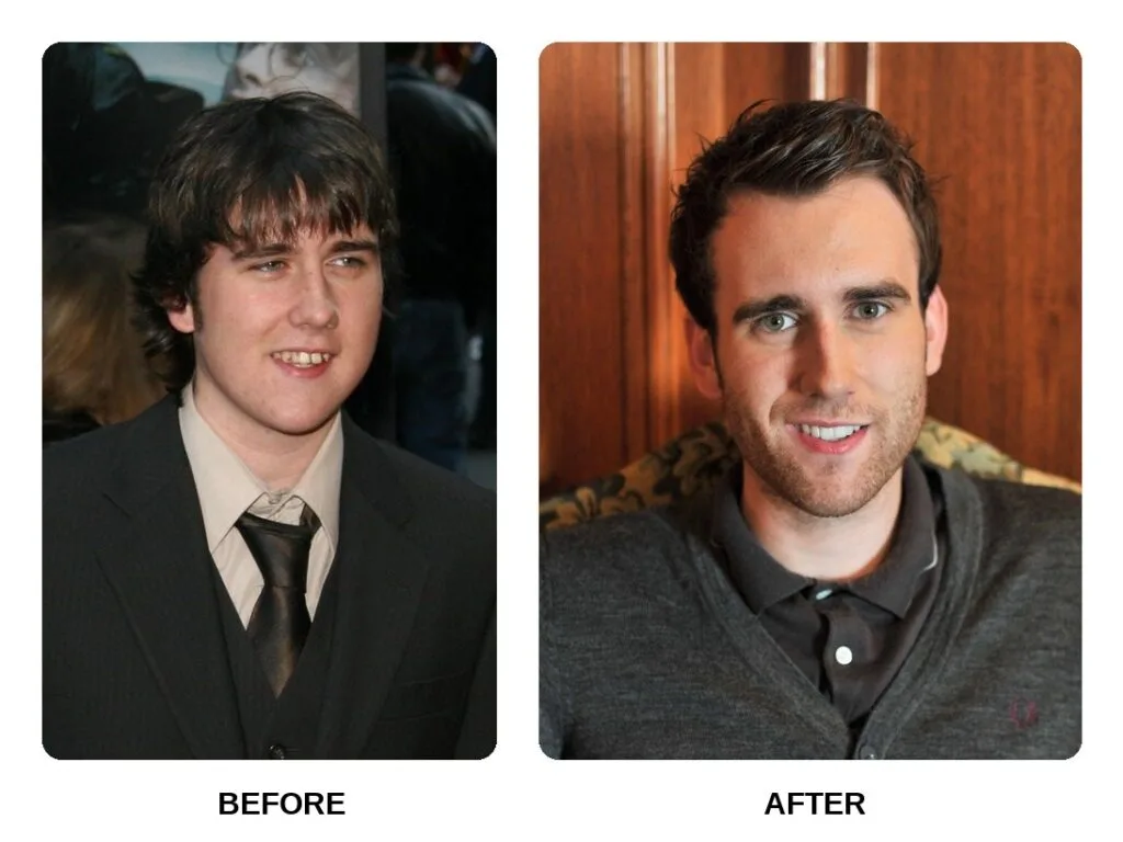 matthew lewis teeth