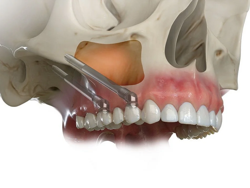 zygomatic implants Turkey cost