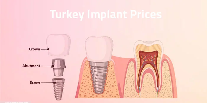 Tarifs des soins en Turquie Grille tarifaire claire et détaillée pour les soins prothétiques et implantaires dans un établissement médical moderne
