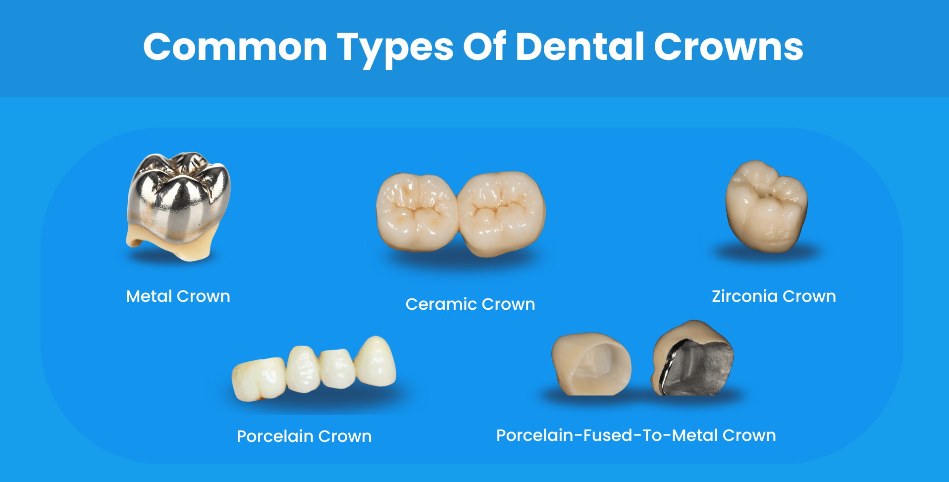 Les types courants de couronnes dentaires et les dents de la personne après le traitement