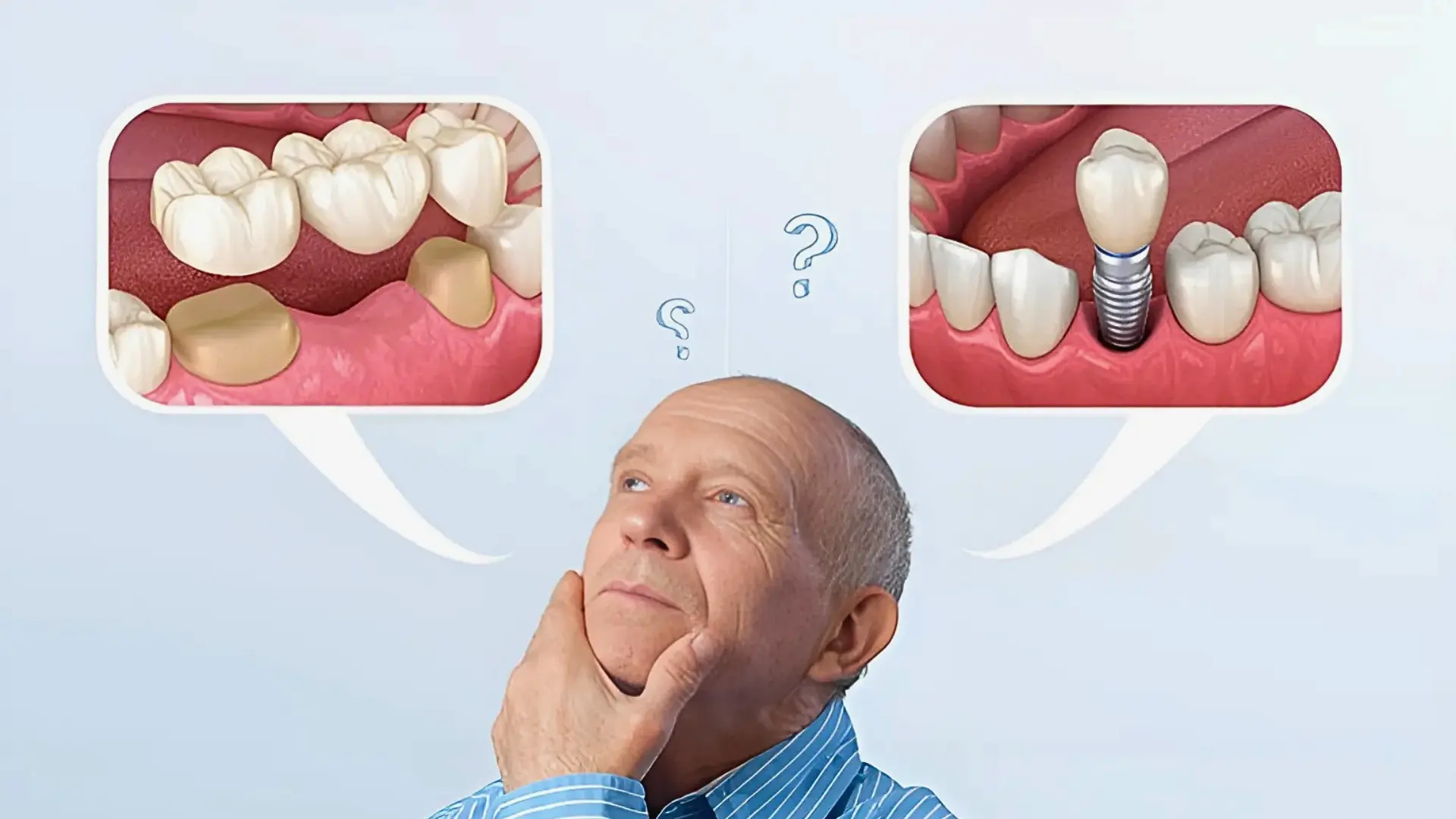Dental Implants vs. Bridges