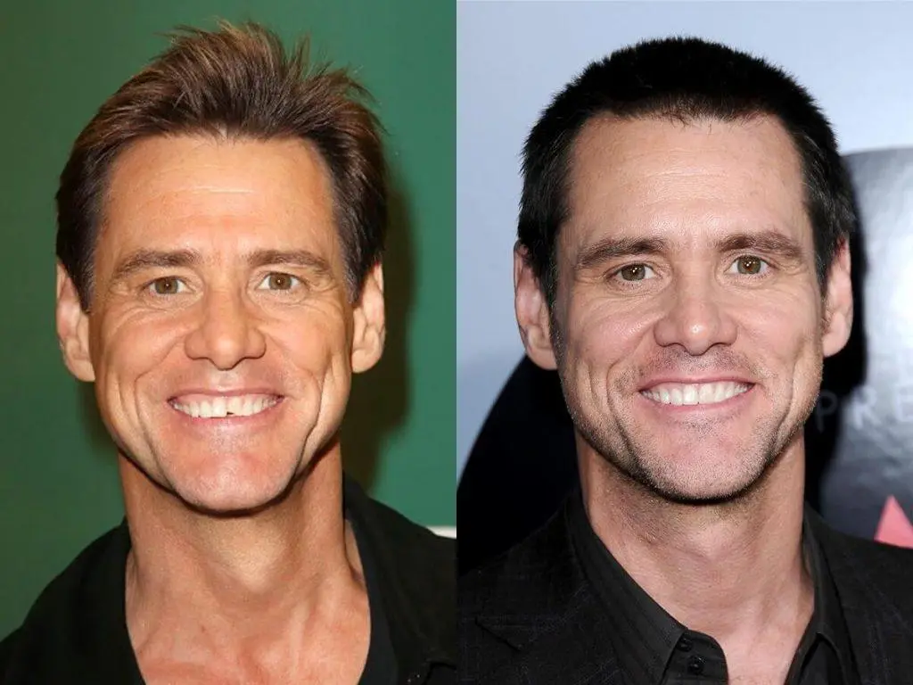jim carrey teeth before and after