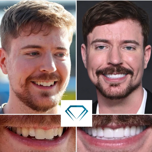 MrBeast Teeth