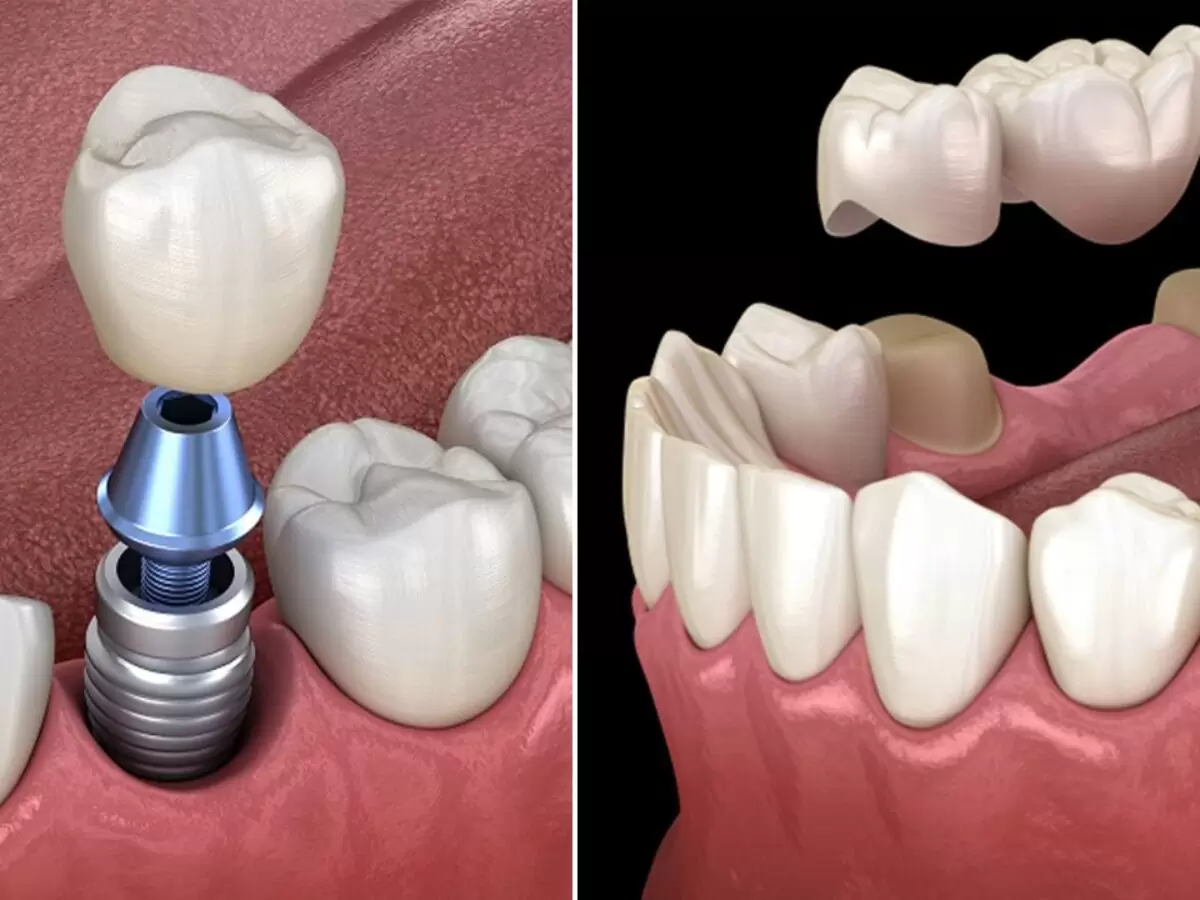 Patient smiling confidently after a painless dental implant procedure