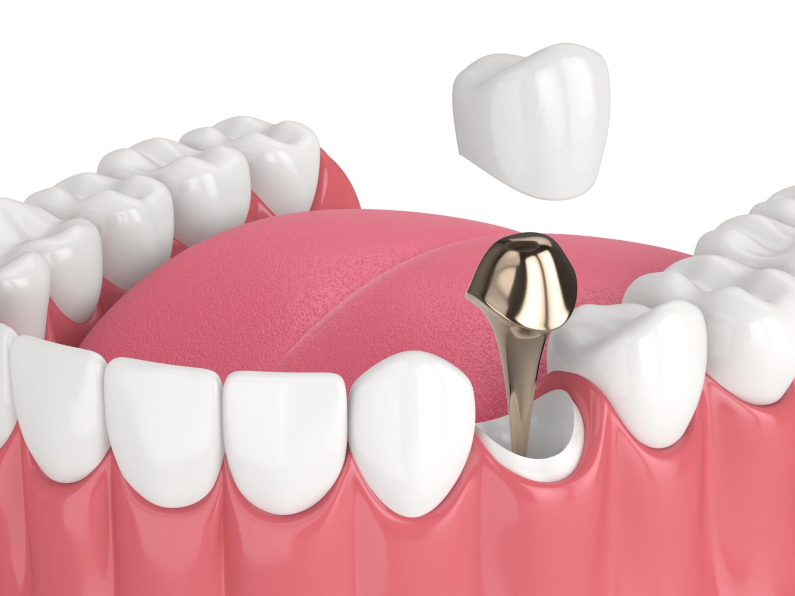 Dental Post and Core Cost Turkey
