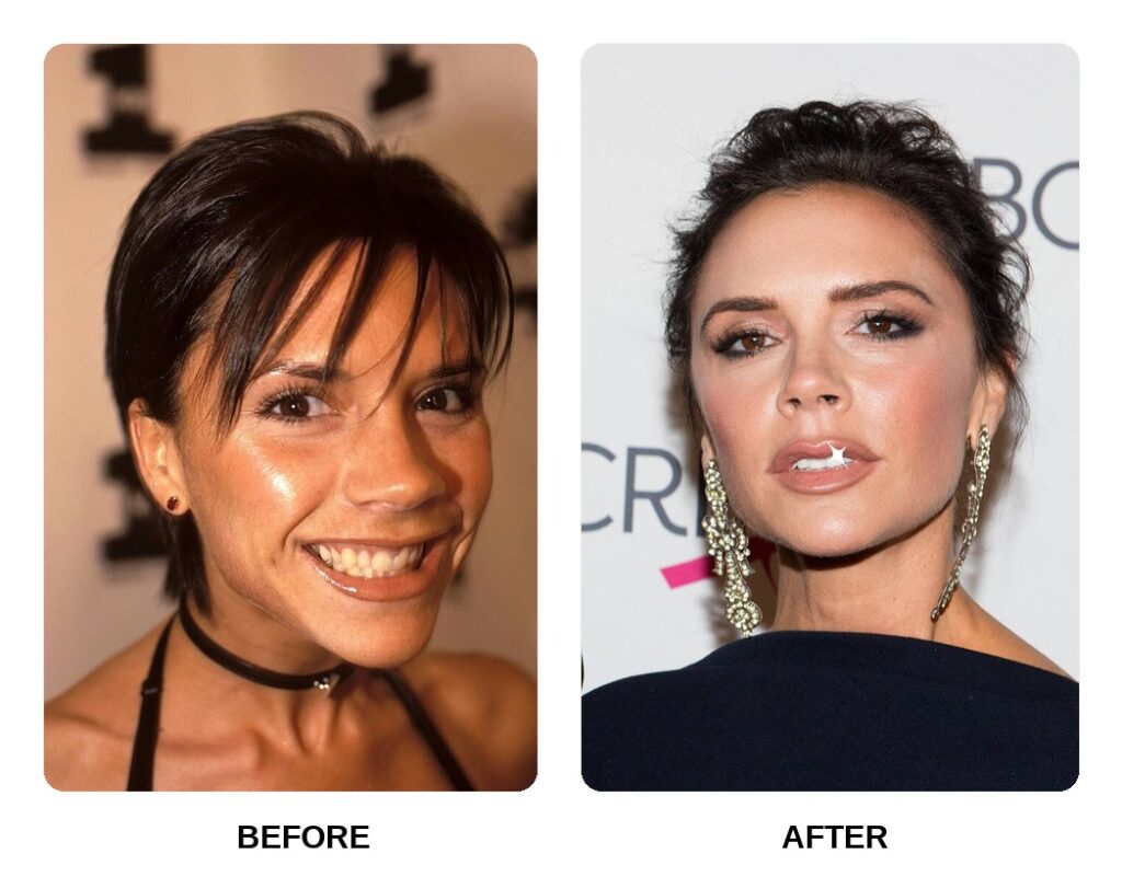 Victoria Beckham teeth