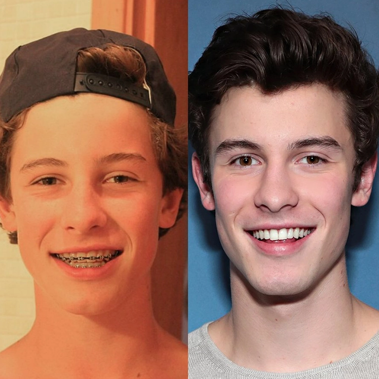 Shawn Mendes Teeth