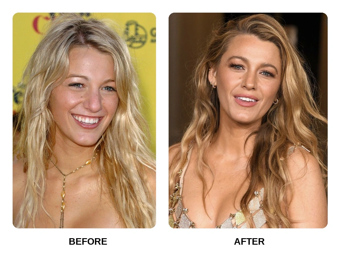 Blake Lively Teeth
