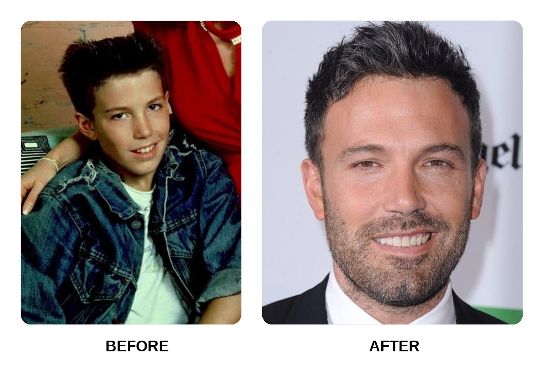 Ben Affleck Teeth