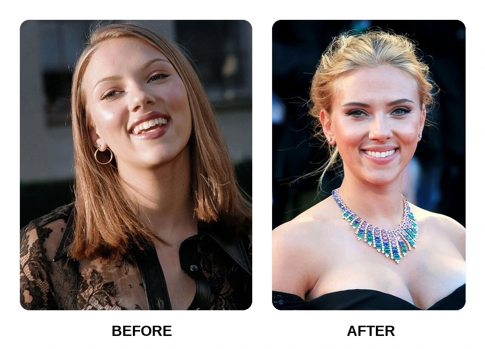 Scarlett Johansson Teeth