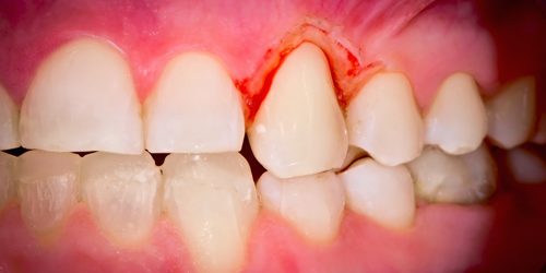 Why Are My Gums Bleeding