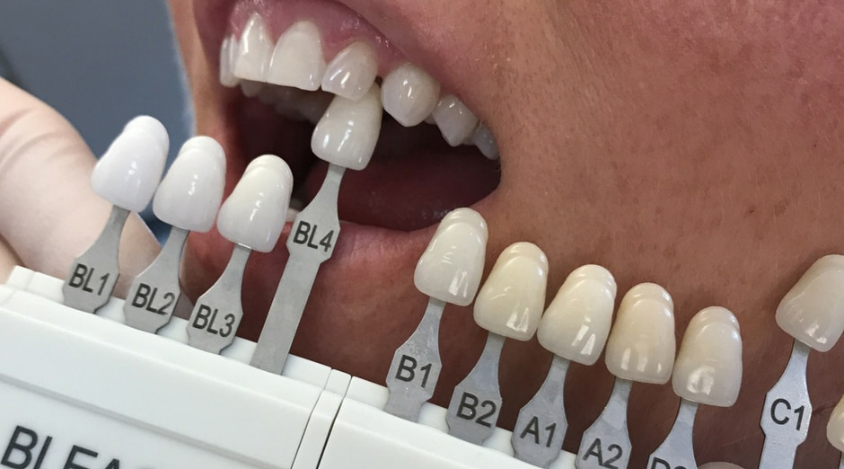 Color of Your Implant Crowns