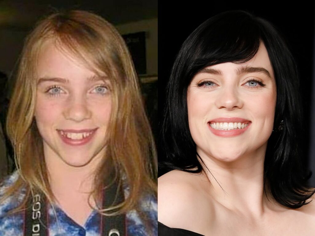 billie-eilish-teeth-before-and-after-2026-complete-dental