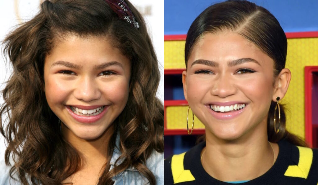 Dents de Zendaya Avant Après 2026 : Analyse de son Hollywood Smile et Transformation Dentaire