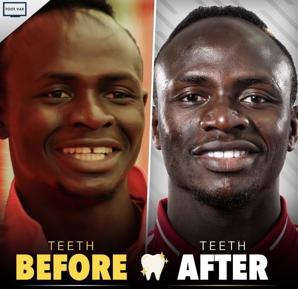 Sadio Mané teeth