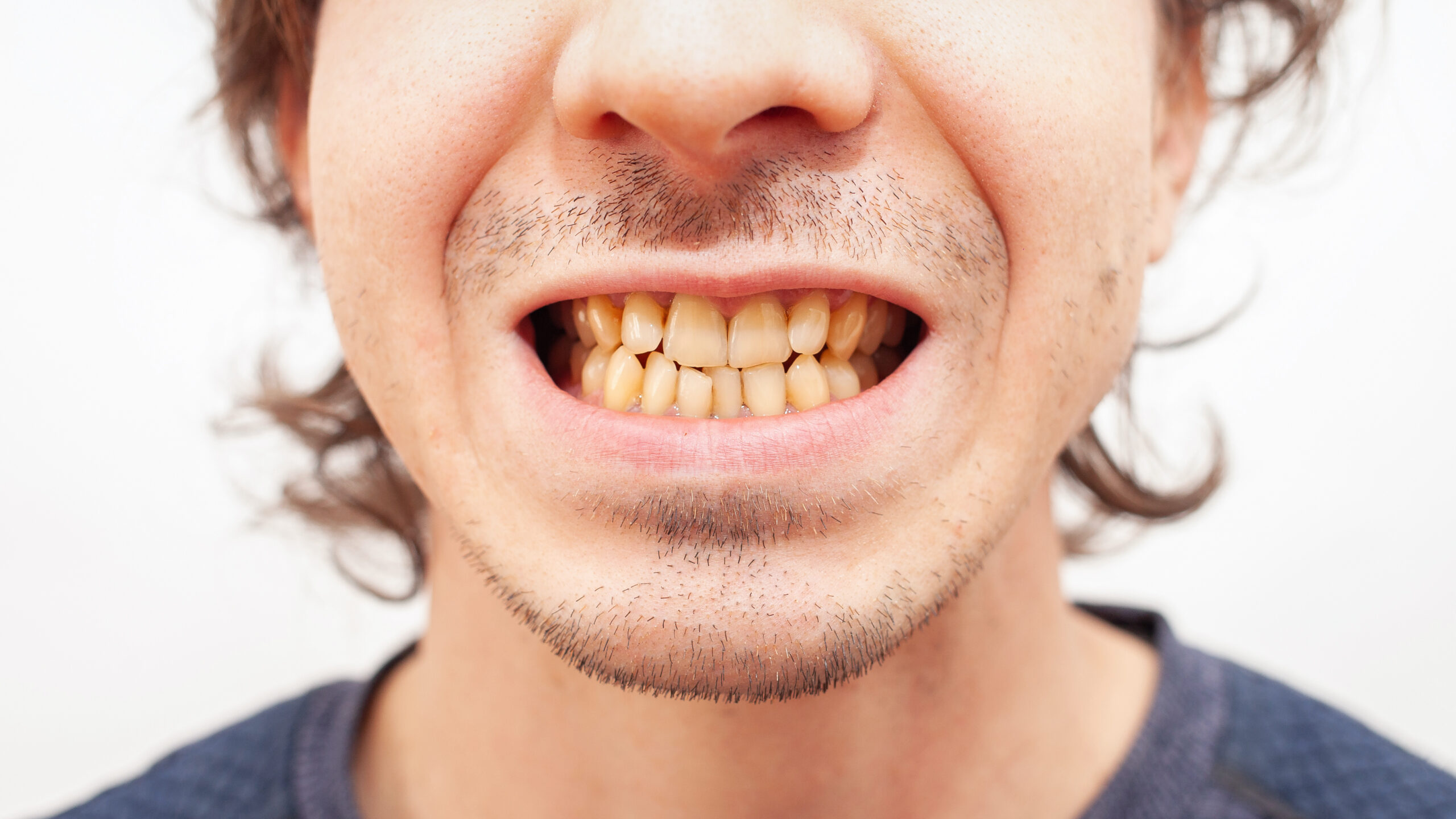 yellow teeth