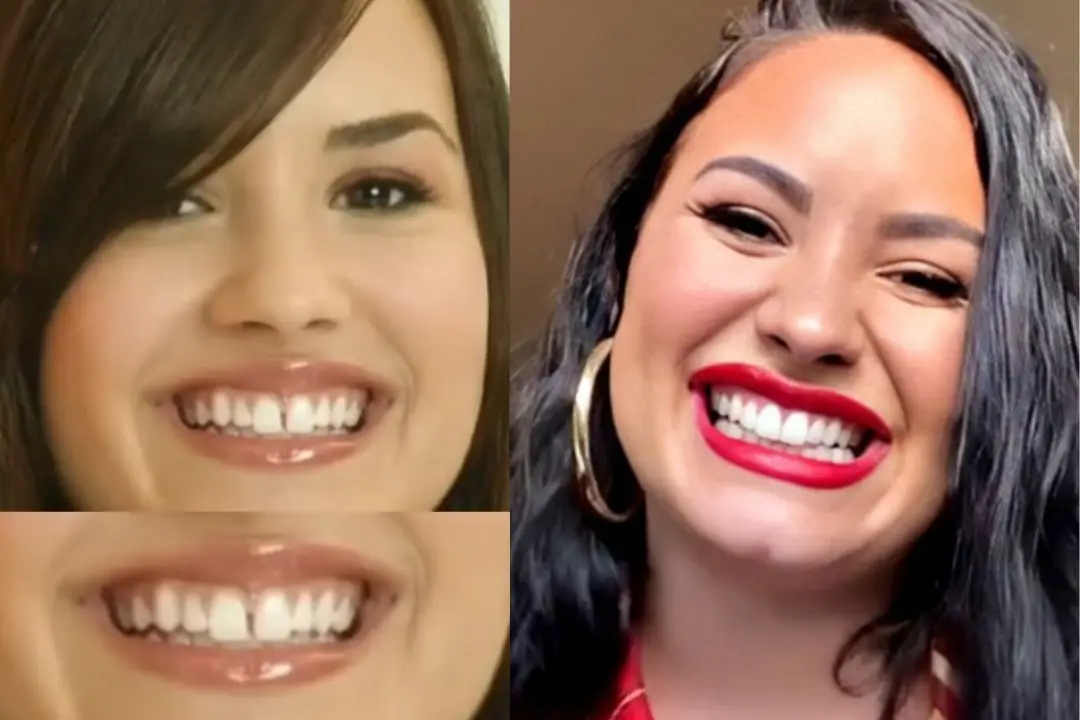 Demi Lovato Teeth