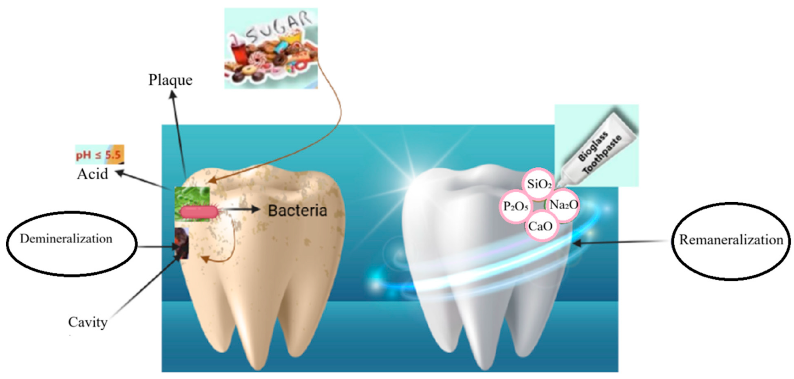 Bioactive Glass vs. Hydroxyapatite