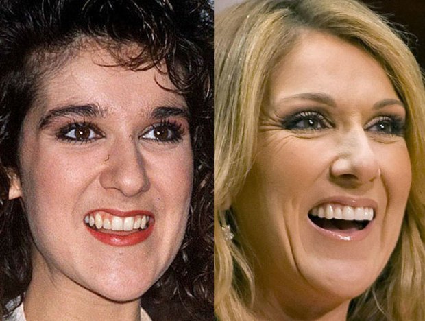 Celine Dion teeth