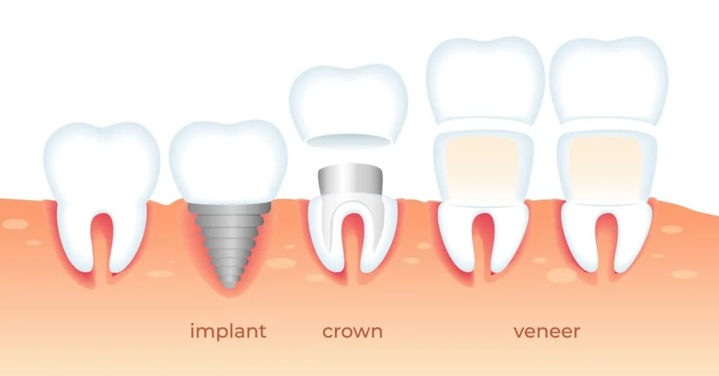 Ingénierie avancée de restauration de facettes et de couronnes sur implants dentaires esthétiques