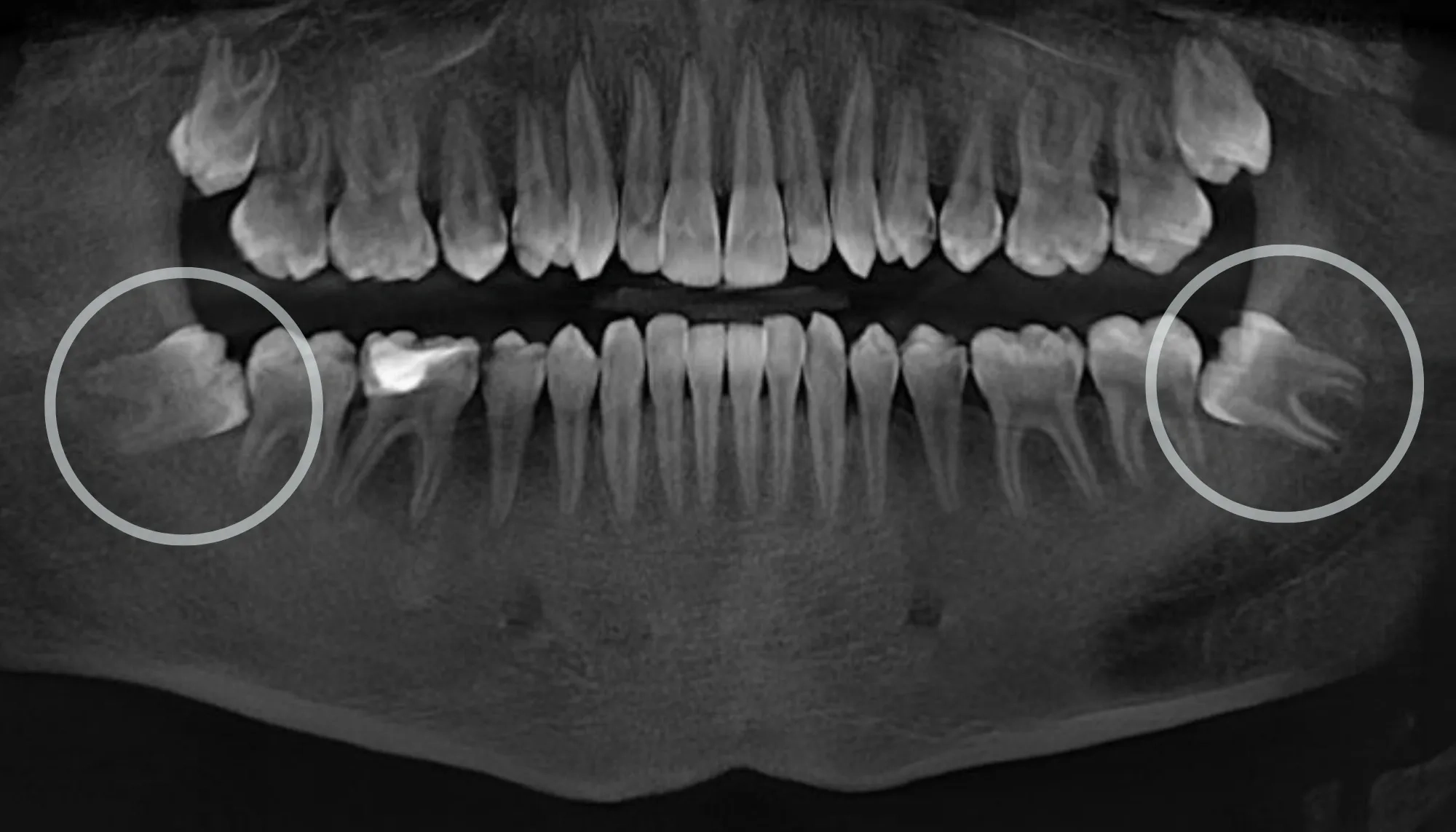 After Wisdom Tooth Extraction