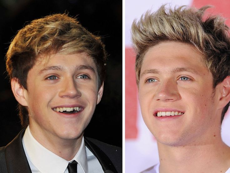 Niall Horan Teeth