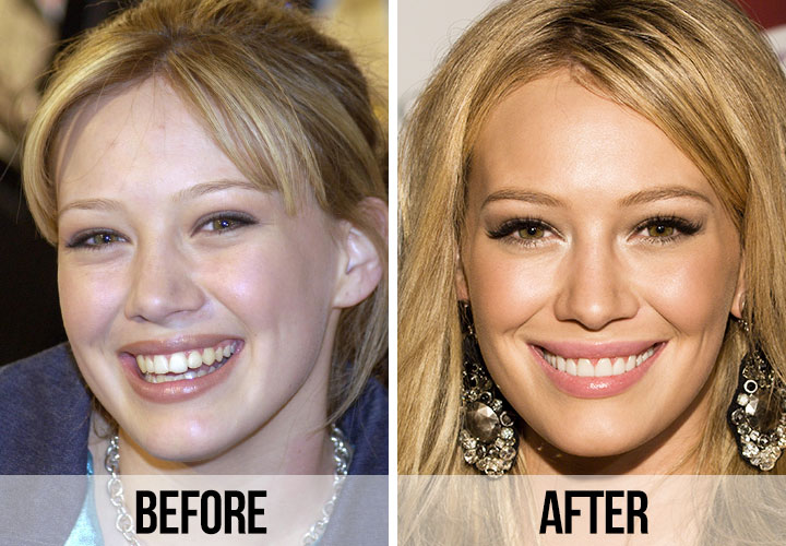 Analyse des Facettes de Célébrités Hilary Duff Hilary Duff dans une analyse dentaire comparant les différentes étapes de ses facettes en porcelaine