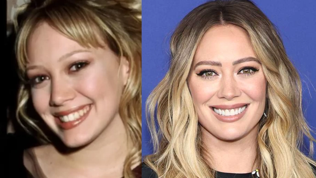 Évolution des Dents de Hilary Duff Avant Après Comparaison des dents de Hilary Duff avant après montrant le sourire d'origine vs les premières facettes