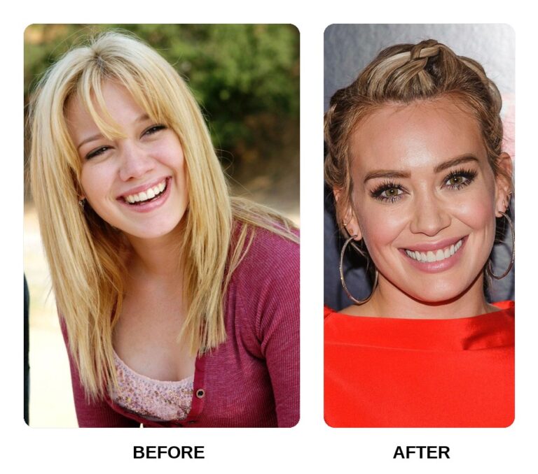 Sourire Moderne de Hilary Duff Hilary Duff dents cover montrant l'esthétique de son sourire moderne en juin 2026