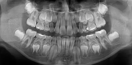 Mixed dentition and natural tooth bud development stages