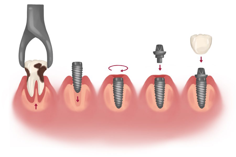 Dental Implant Immediately After Tooth Extraction