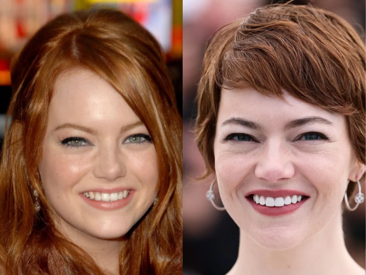 Dents d Emma Stone avant transformation montrant son sourire naturel