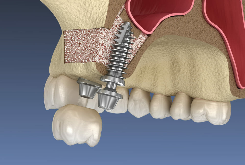 Sinus lift surgery explained before and after bone graft integration
