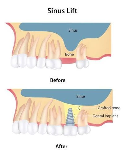 Sinus lift surgery explained before and after 3D radiography image