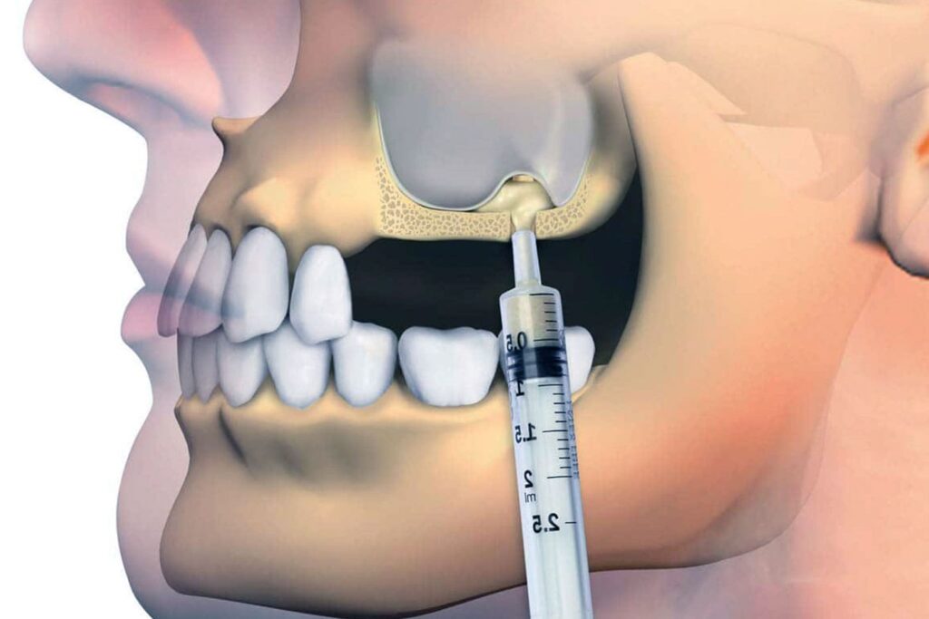 Sinus Lift Surgery Explained
