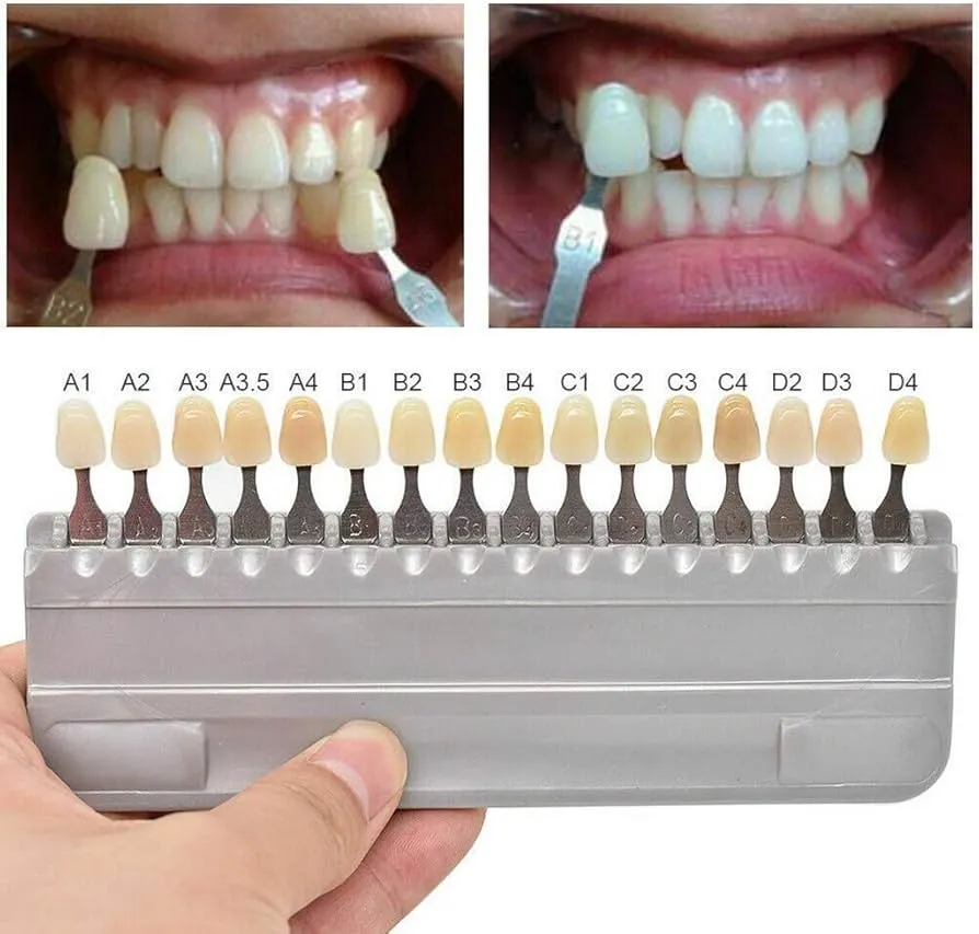 Comparison of A1 vs. B1 tooth shade for dental restorations
