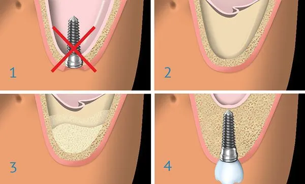 dental sinus lift procedure diagram showing maxillary sinus elevation